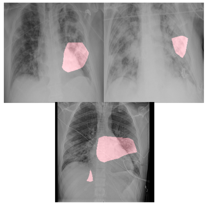 Algorithme de détection du coronavirus Covid-net
